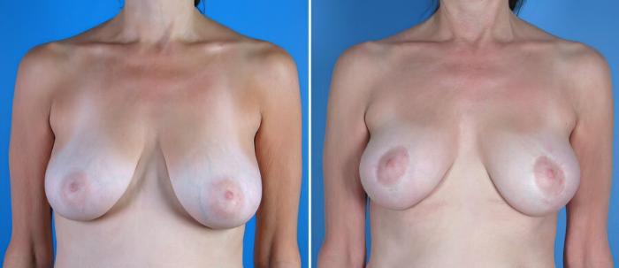 Breast Lift Before & After Case 17951