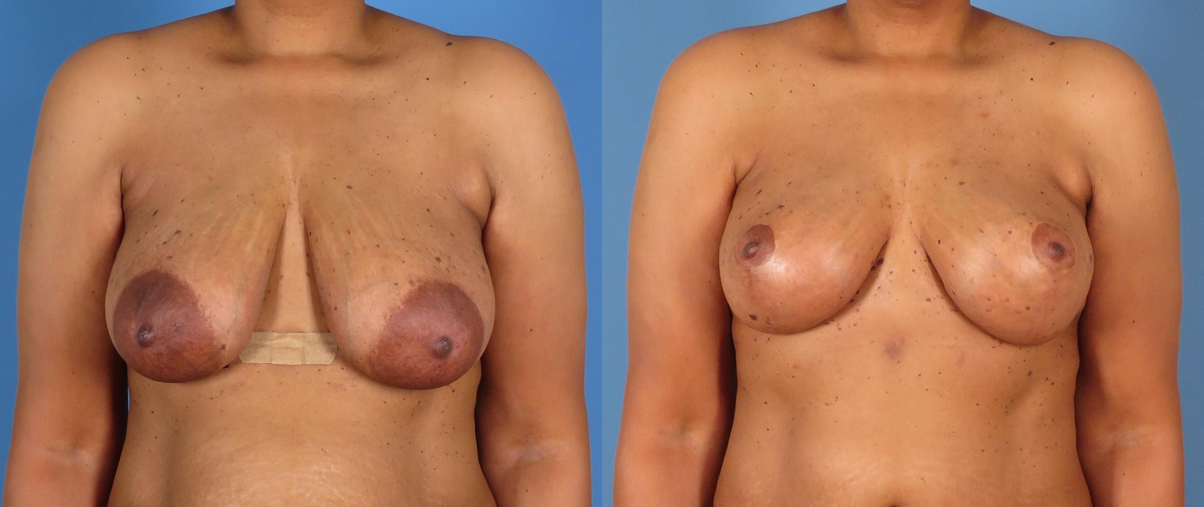 Breast Lift Before & After Case 28307