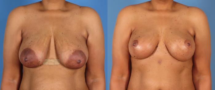 Breast Lift Before & After Case 28307