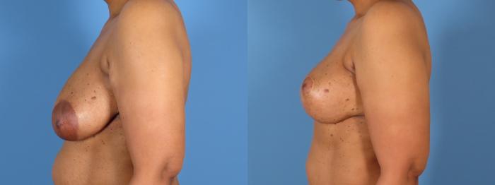Breast Lift Before & After Case 28307