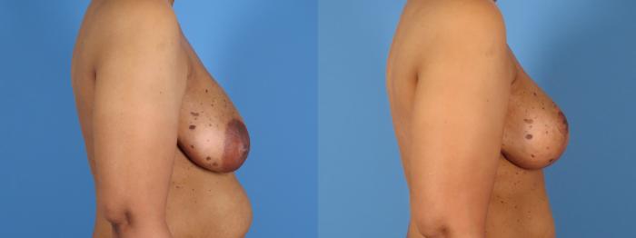 Breast Lift Before & After Case 28307