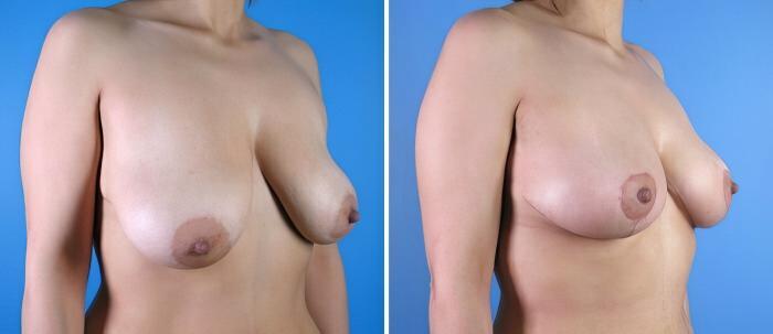 Breast Reduction Before & After Case 17886