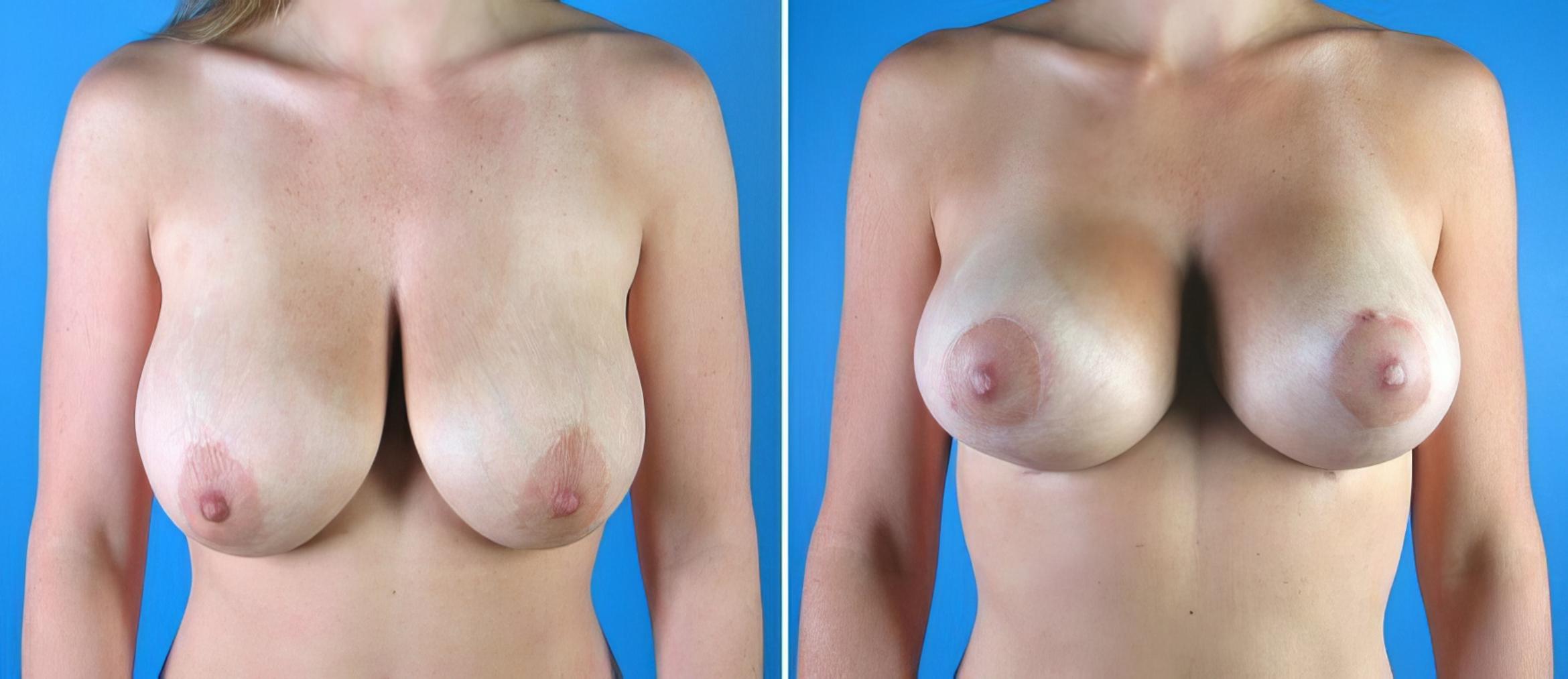 Breast Reduction Before & After Case 17916