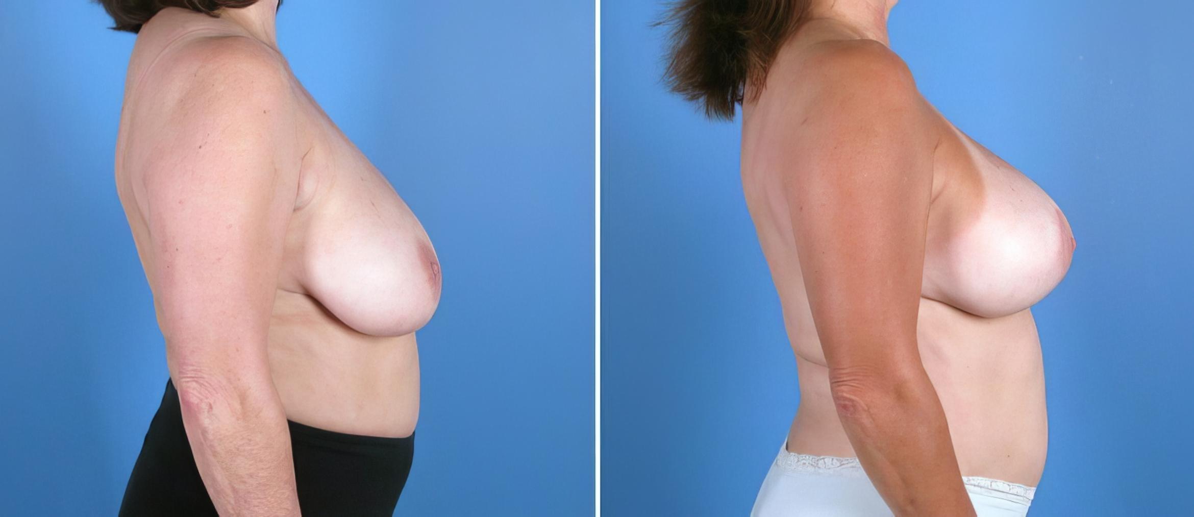 Breast Reduction Before & After Case 17941
