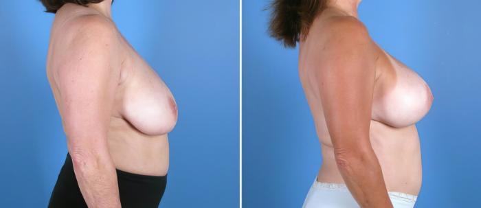 Breast Reduction Before & After Case 17941