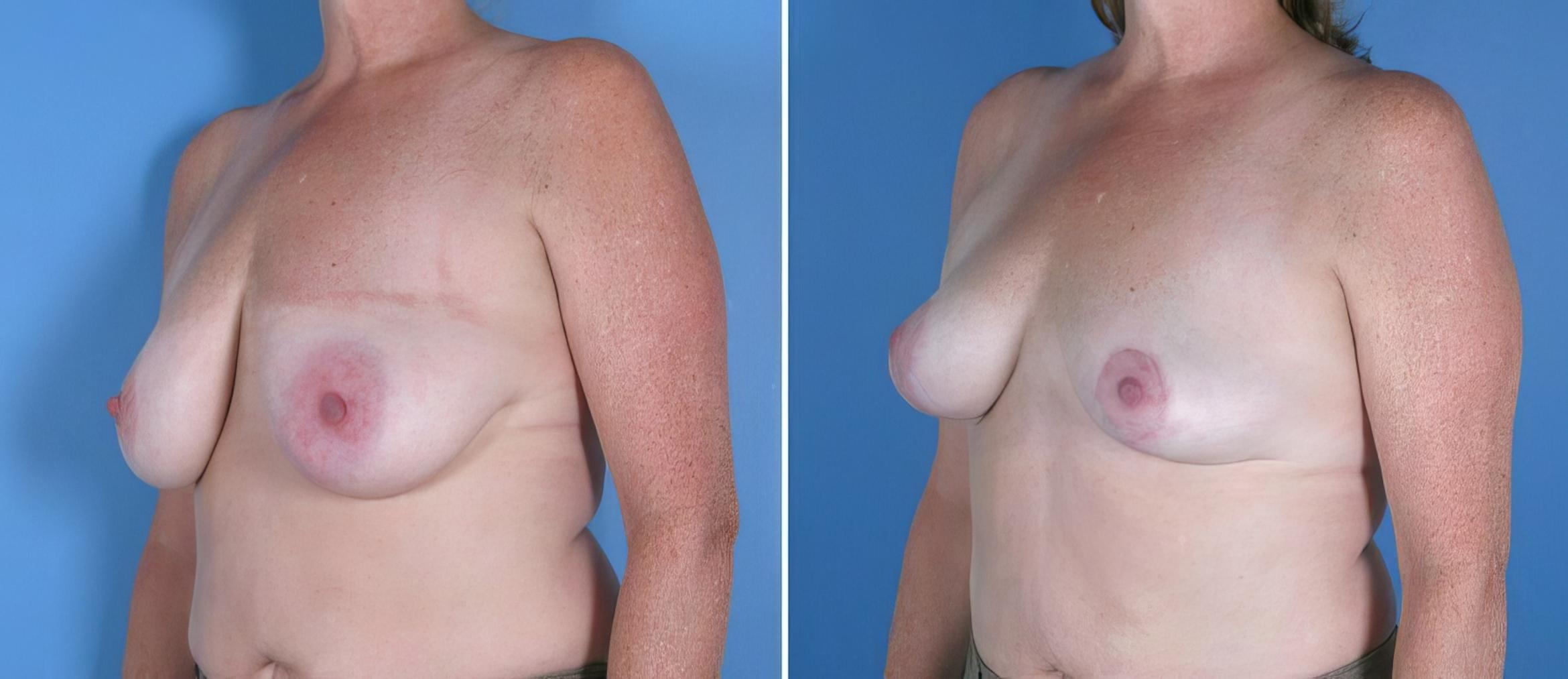 Breast Reduction Before & After Case 17954
