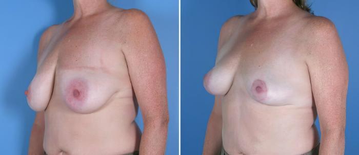 Breast Reduction Before & After Case 17954