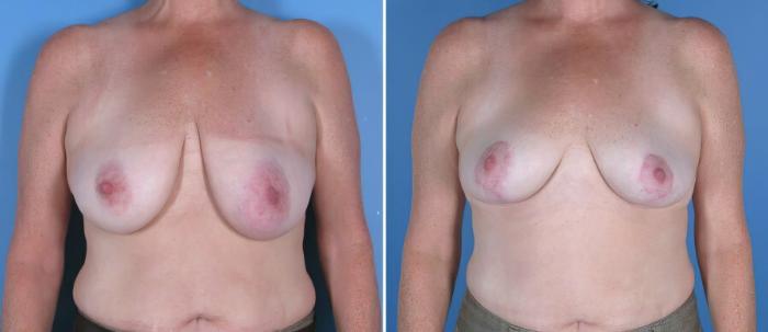 Breast Reduction Before & After Case 17954
