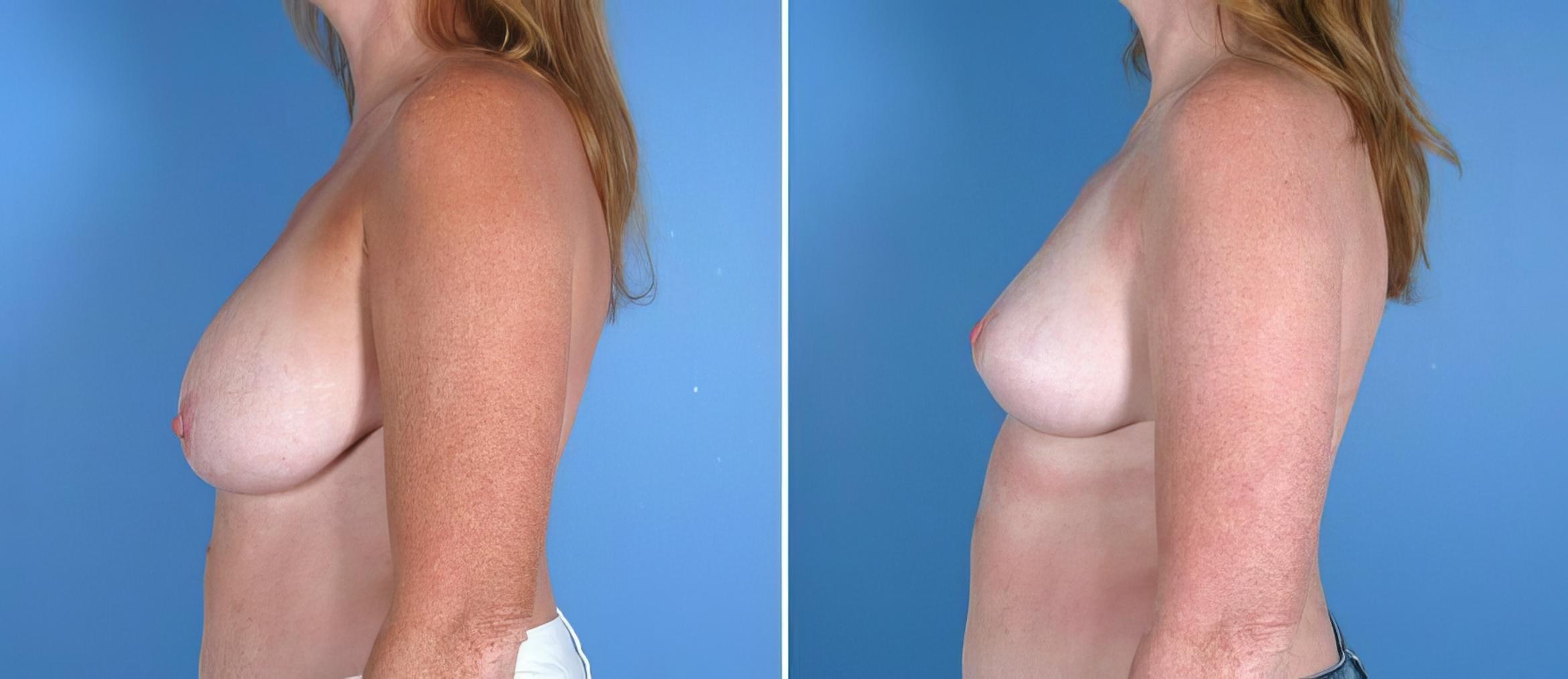 Breast Reduction Before & After Case 17957