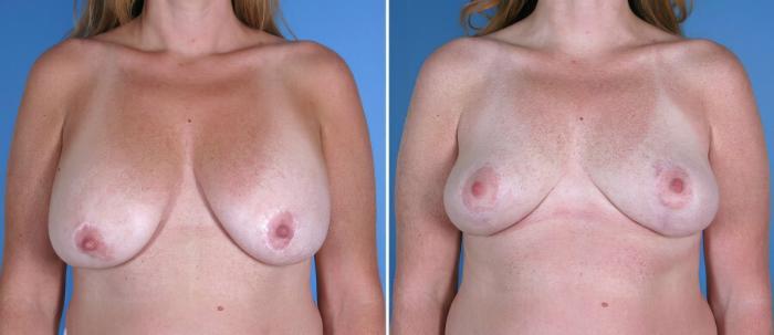 Breast Reduction Before & After Case 17957