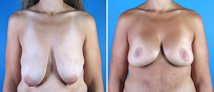 Breast Reduction Before & After Case 17963