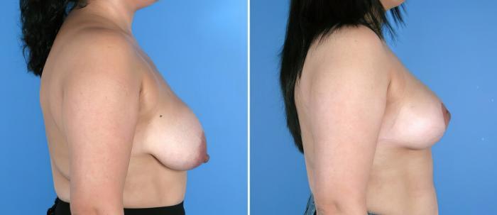 Breast Reduction Before & After Case 17966