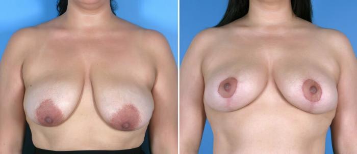 Breast Reduction Before & After Case 17966