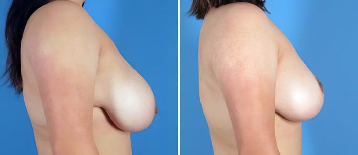 Breast Reduction Before & After Case 25504