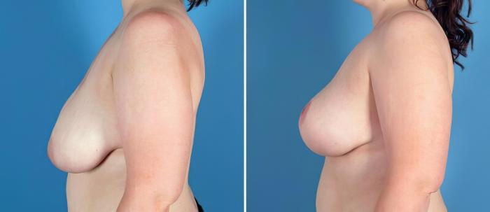 Breast Reduction Before & After Case 25624