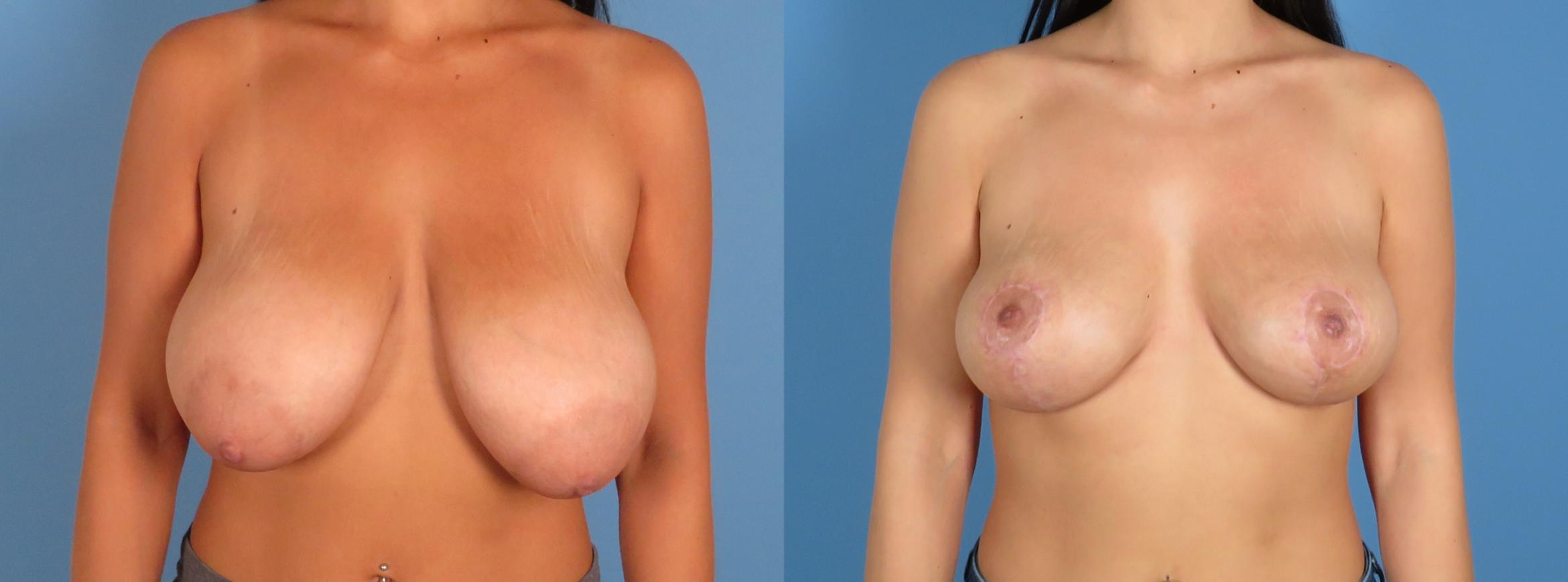 Breast Reduction Before & After Case 28313
