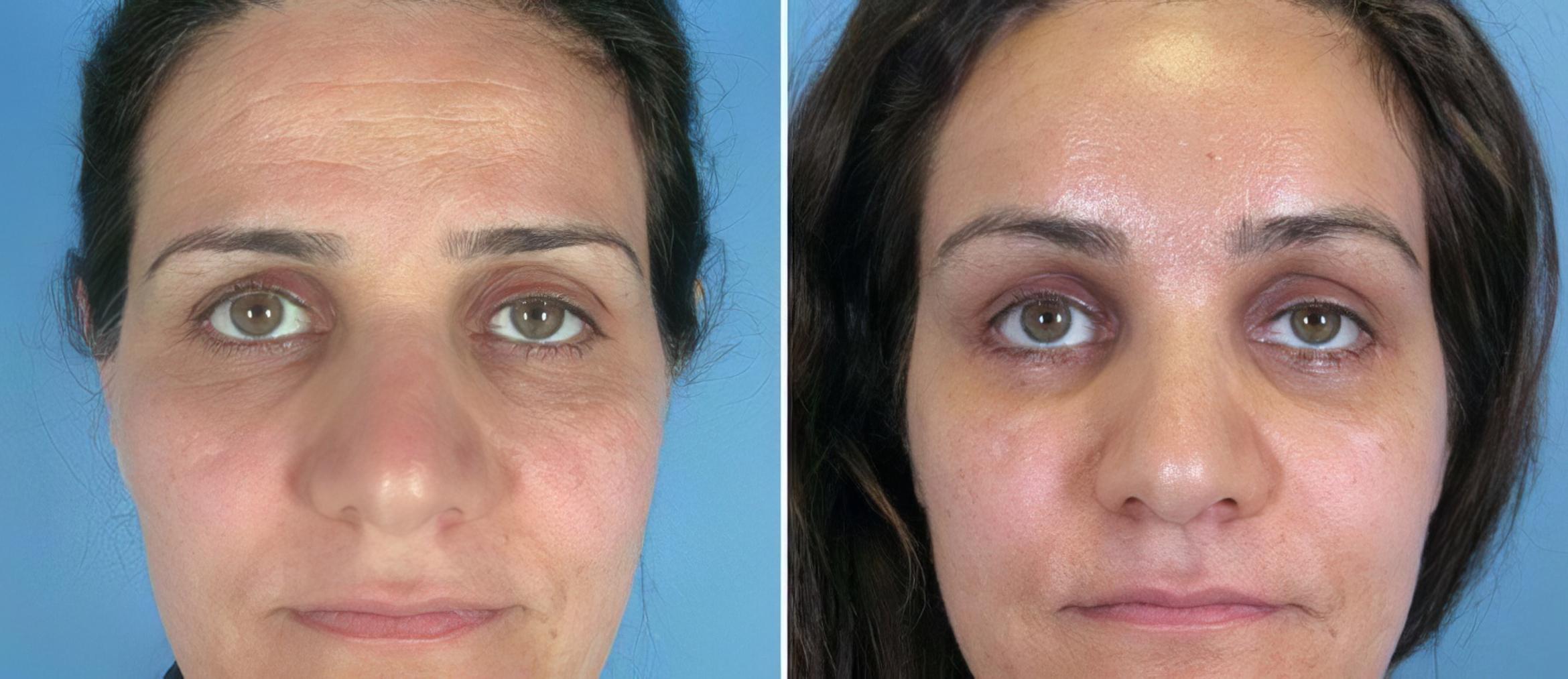 Brow Lift Before & After Case 17449