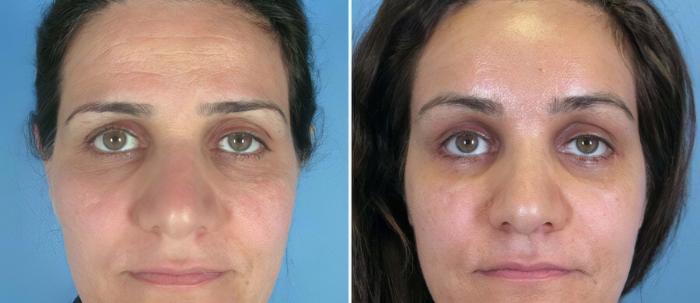 Brow Lift Before & After Case 17449