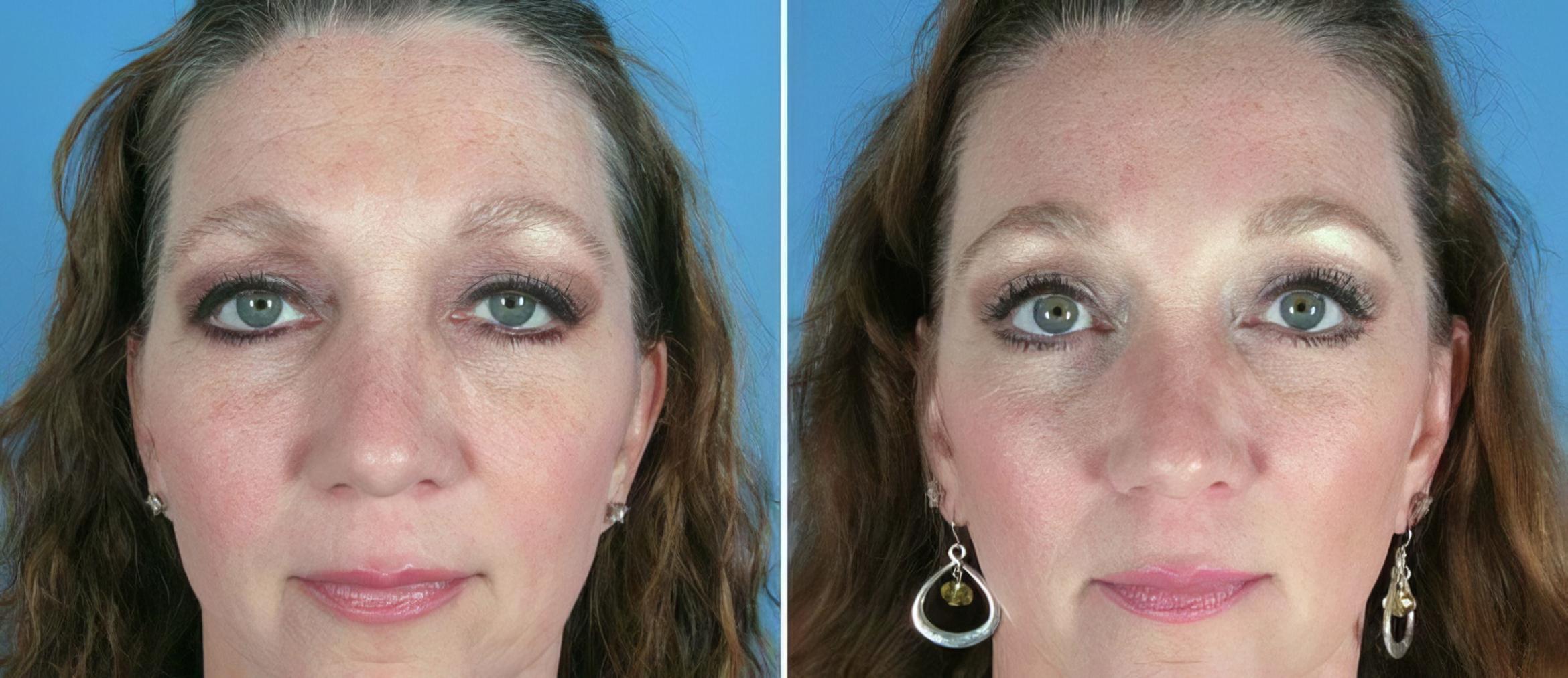Brow Lift Before & After Case 17451