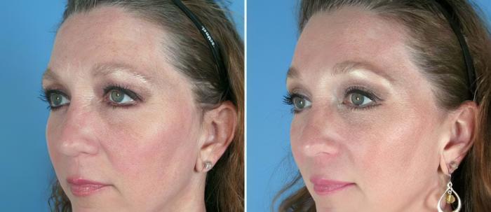Brow Lift Before & After Case 17451