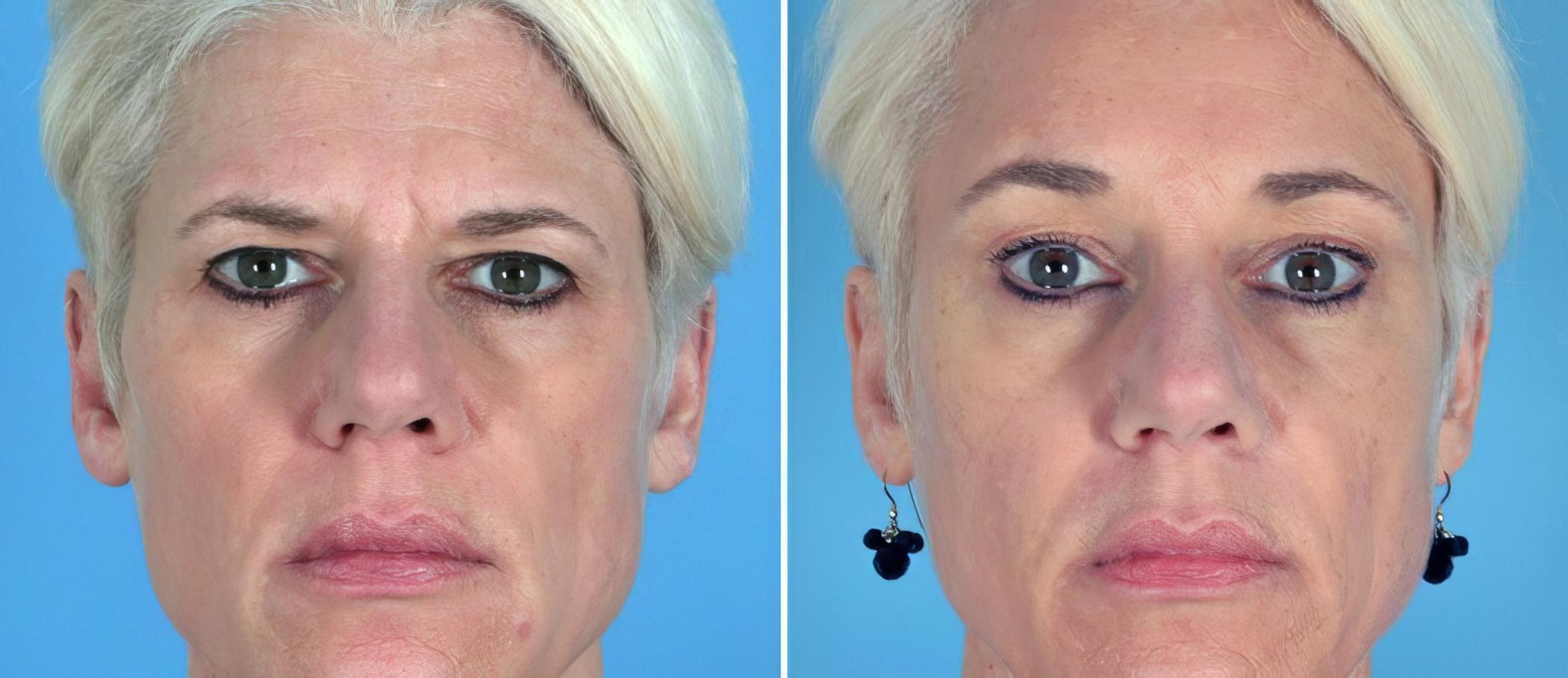 Brow Lift Before & After Case 17459