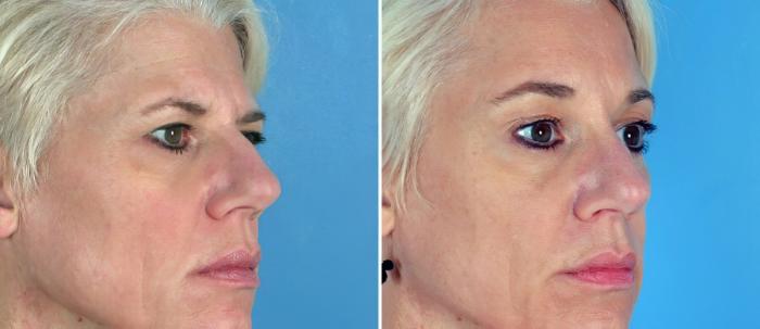Brow Lift Before & After Case 17459