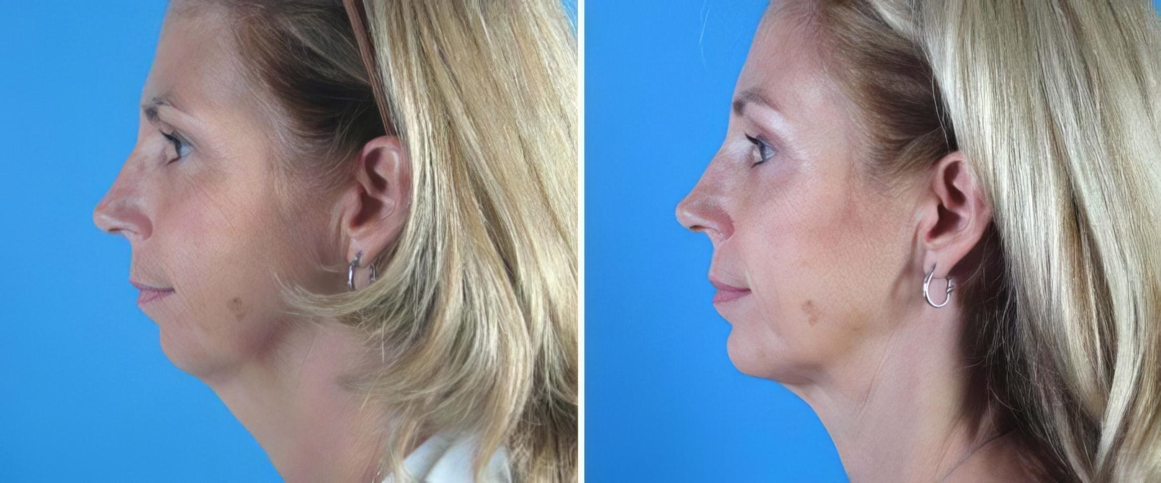Chin Augmentation / Neck Lift Before & After Case 18145