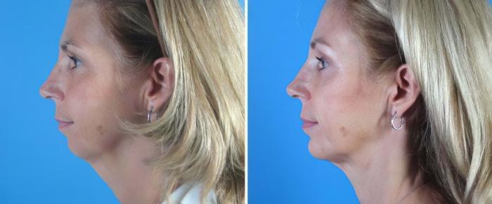 Chin Augmentation / Neck Lift Before & After Case 18145