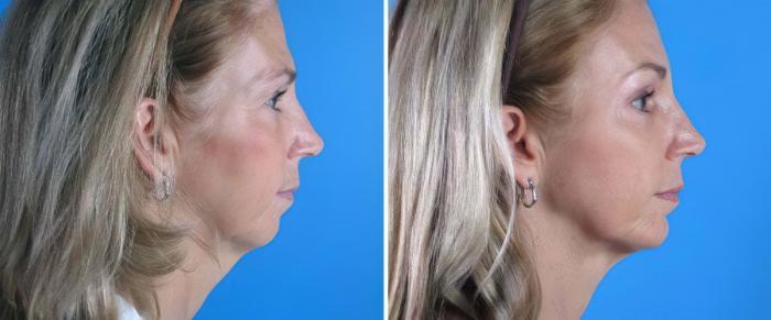 Chin Augmentation / Neck Lift Before & After Case 18145