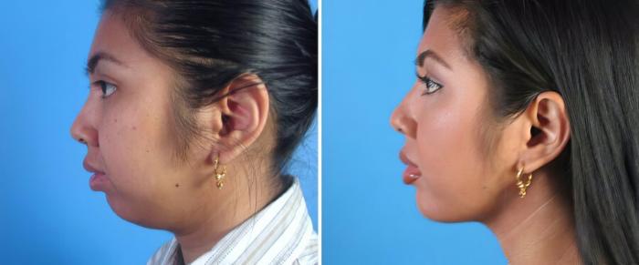 Chin Augmentation / Neck Lift Before & After Case 18148