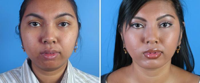 Chin Augmentation / Neck Lift Before & After Case 18148