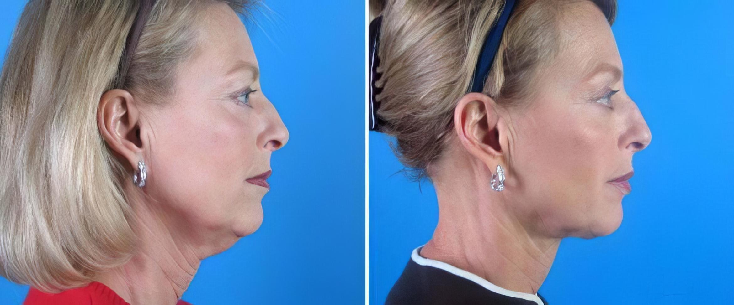 Chin & Neck Liposuction Before & After Case 19341
