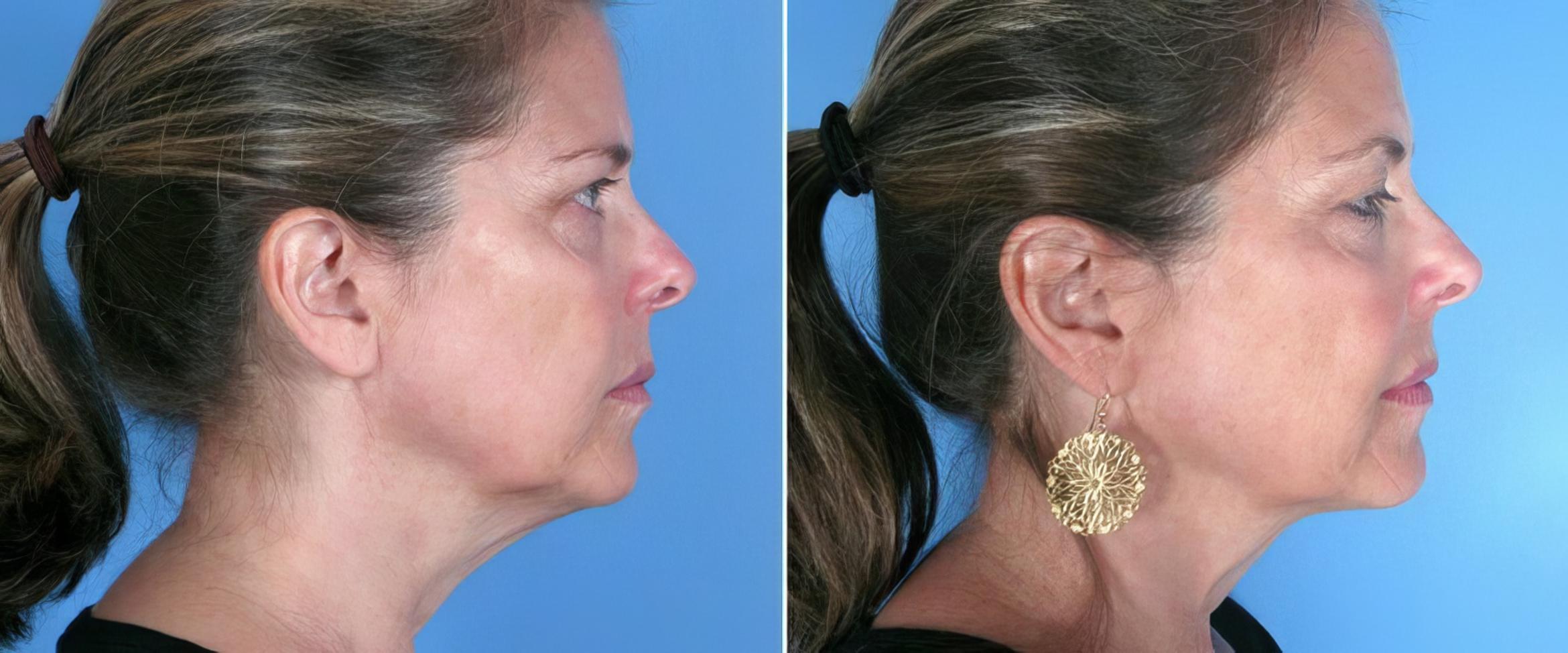 Chin & Neck Liposuction Before & After Case 19364