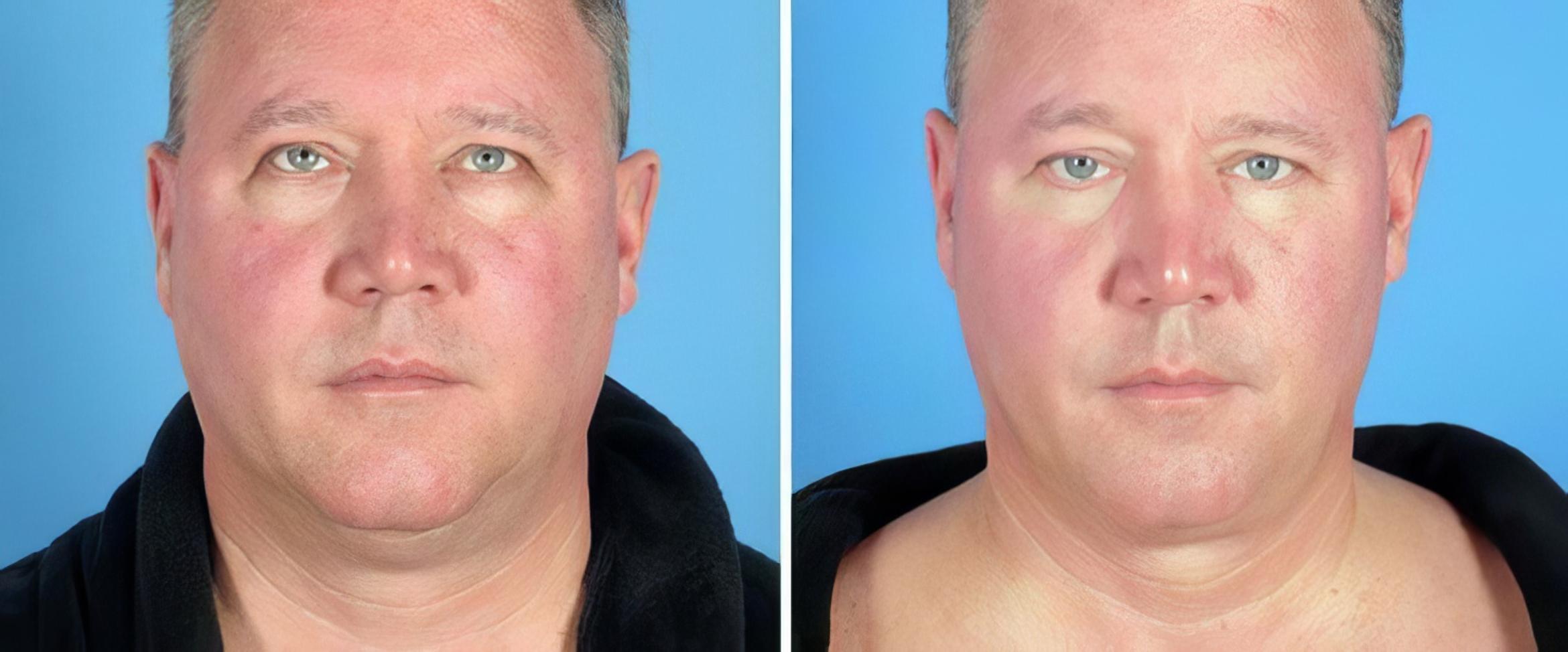 Chin & Neck Liposuction Before & After Case 25519