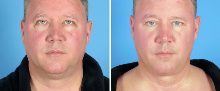 Chin & Neck Liposuction Before & After Case 25519