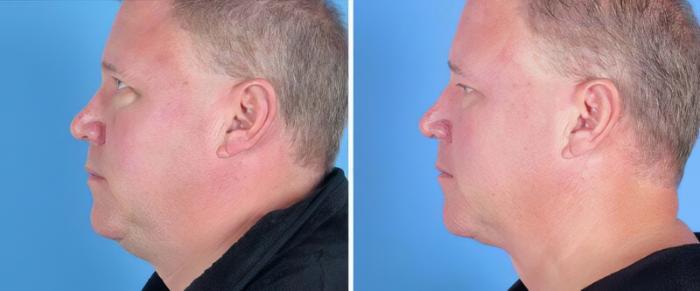 Chin & Neck Liposuction Before & After Case 25519
