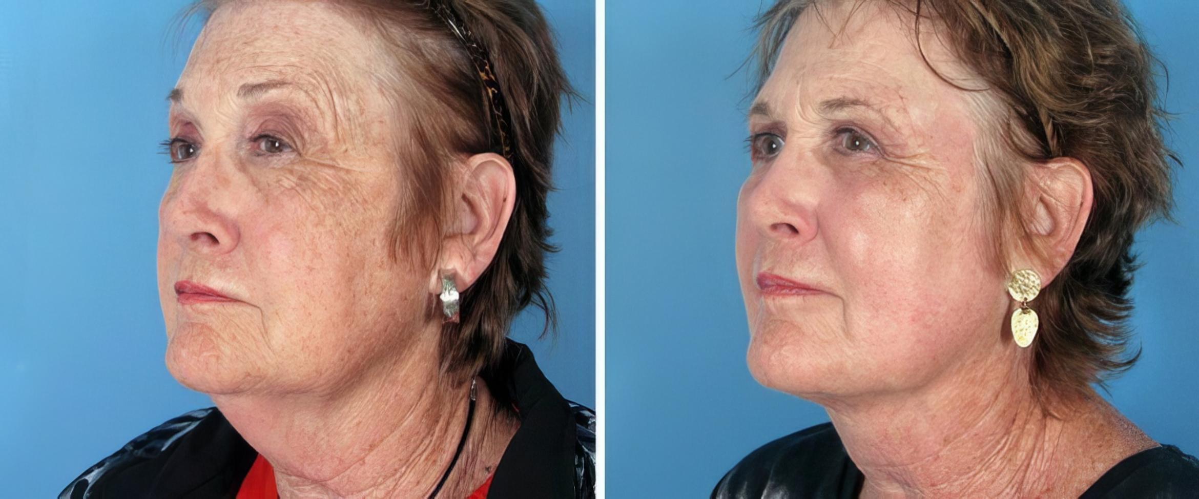 Chin & Neck Liposuction Before & After Case 25797