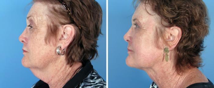 Chin & Neck Liposuction Before & After Case 25797