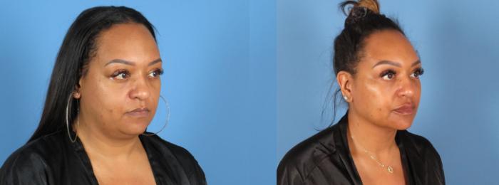 Chin & Neck Liposuction Before & After Case 28306