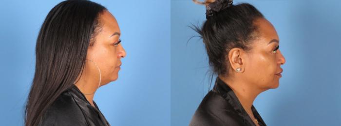 Chin & Neck Liposuction Before & After Case 28306