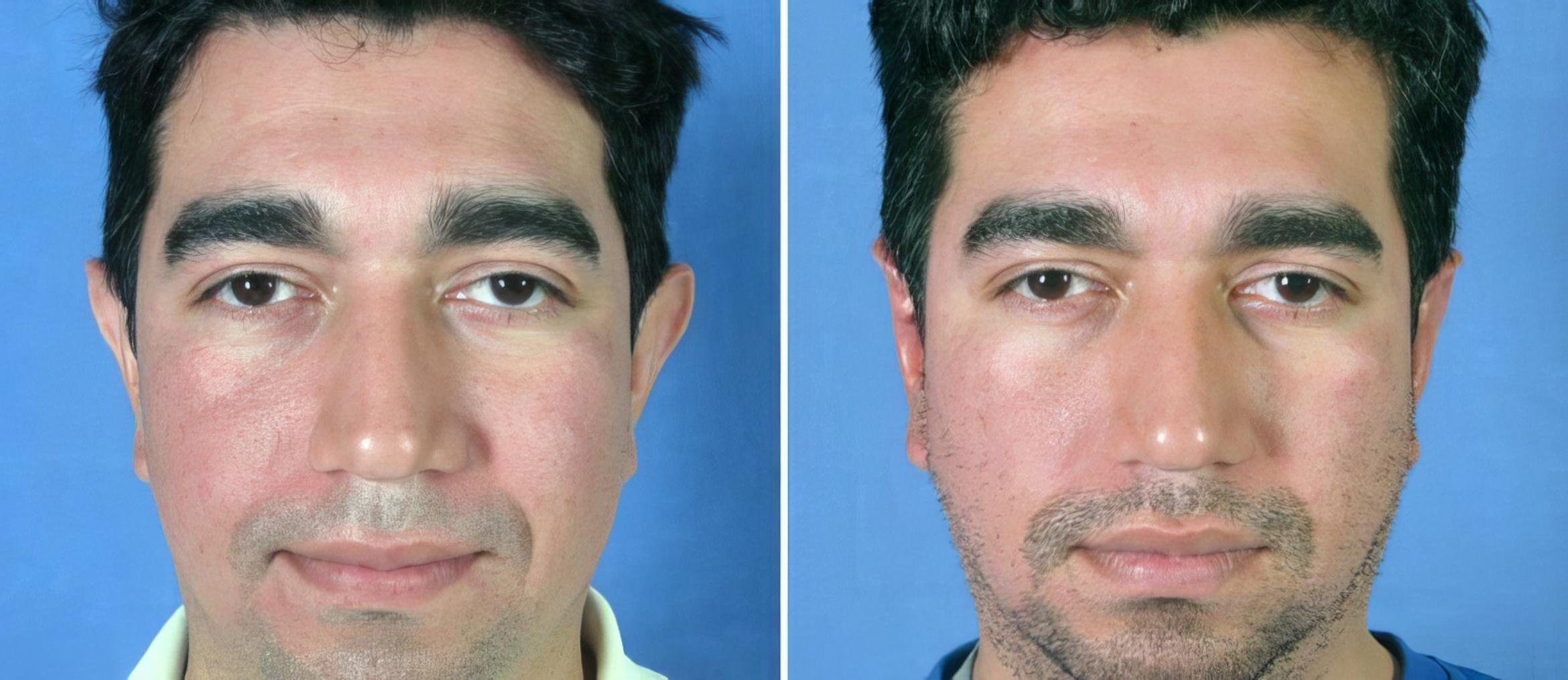 Ear Reshaping Before & After Case 17344