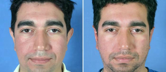 Ear Reshaping Before & After Case 17344