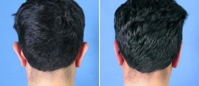Ear Reshaping Before & After Case 17344