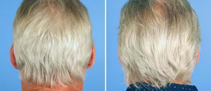 Ear Reshaping Before & After Case 17465