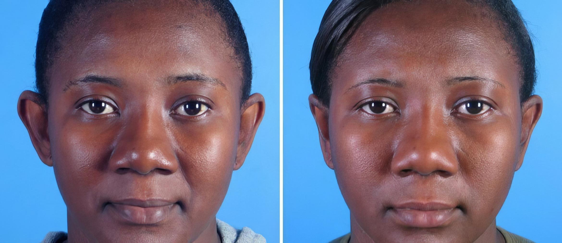 Ear Reshaping Before & After Case 17471