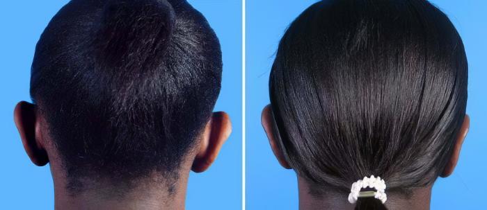 Ear Reshaping Before & After Case 17471