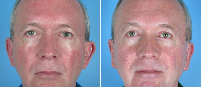 Ear Reshaping Before & After Case 17477