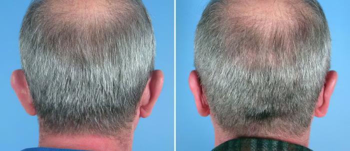 Ear Reshaping Before & After Case 17477