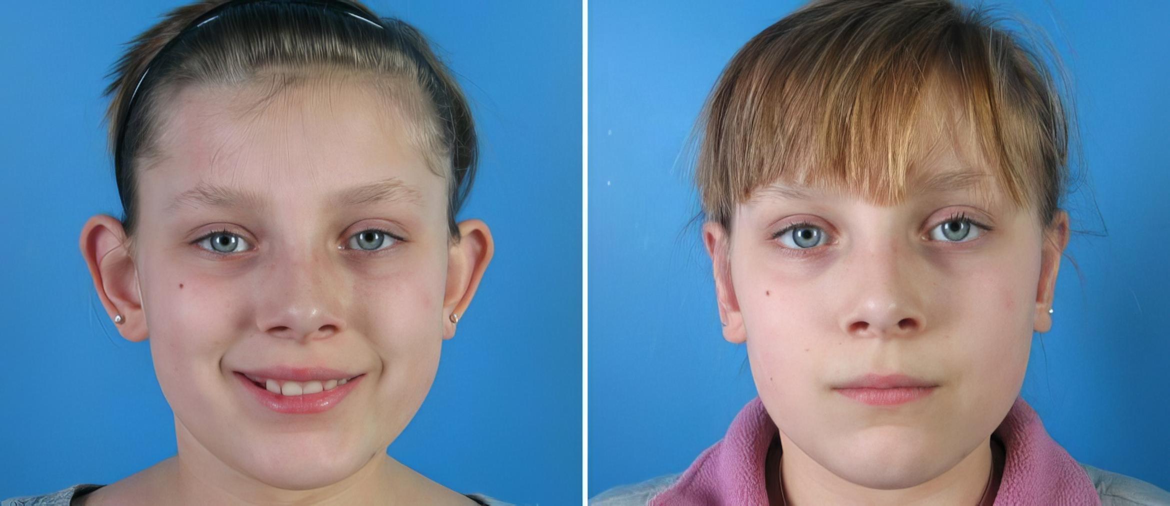 Ear Reshaping Before & After Case 18154