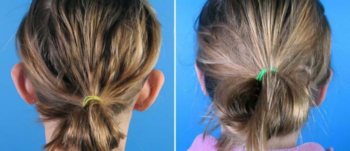 Ear Reshaping Before & After Case 18154